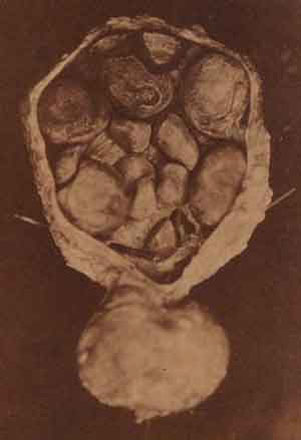 bladder stones